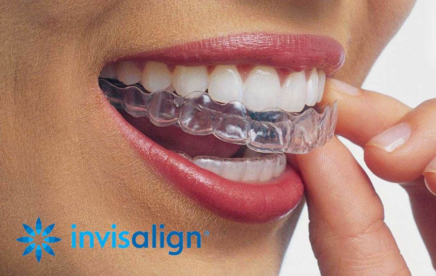 Invisalign image